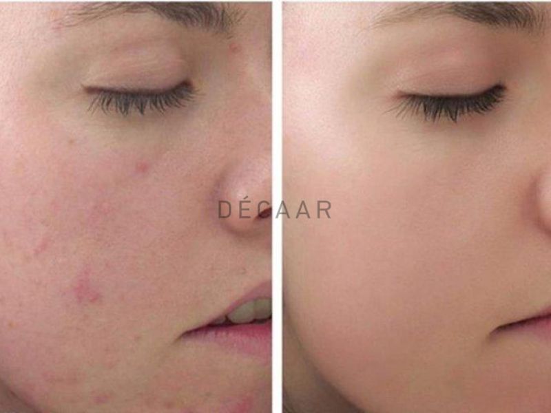 Ưu điểm của peel da